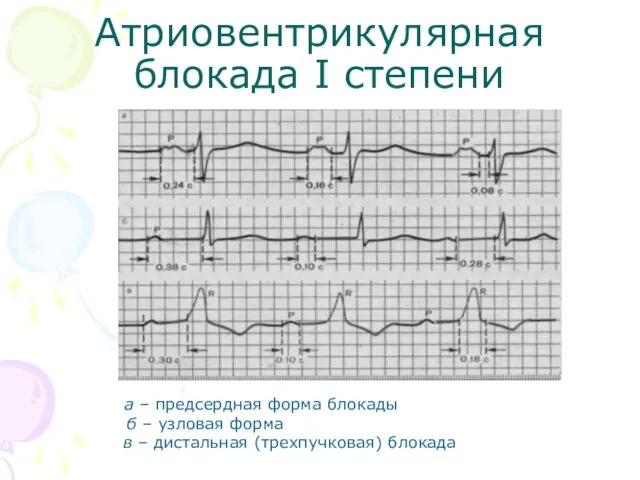 Атриовентрикулярная блокада I степени а – предсердная форма блокады б –