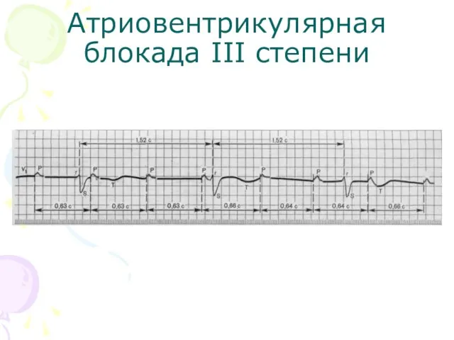 Атриовентрикулярная блокада III степени