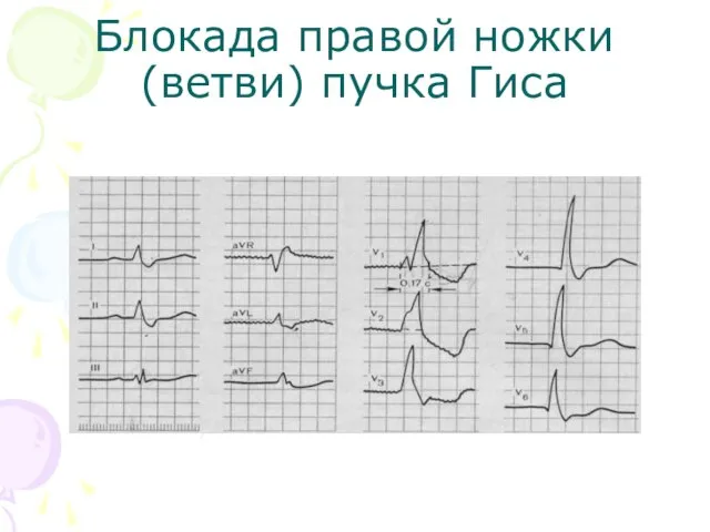 Блокада правой ножки (ветви) пучка Гиса