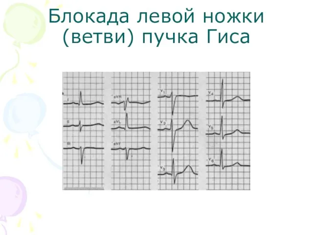 Блокада левой ножки (ветви) пучка Гиса