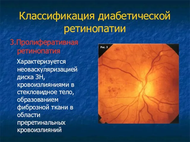 Классификация диабетической ретинопатии 3.Пролиферативная ретинопатия Характеризуется неоваскуляризацией диска ЗН, кровоизлияниями в