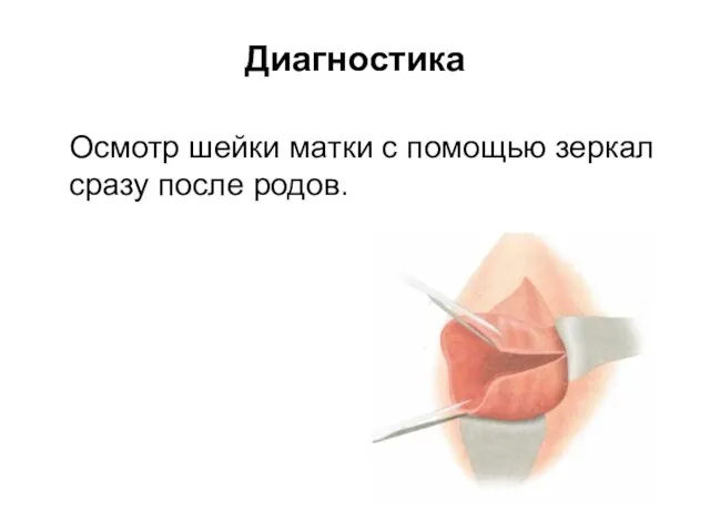 Диагностика Осмотр шейки матки с помощью зеркал сразу после родов.