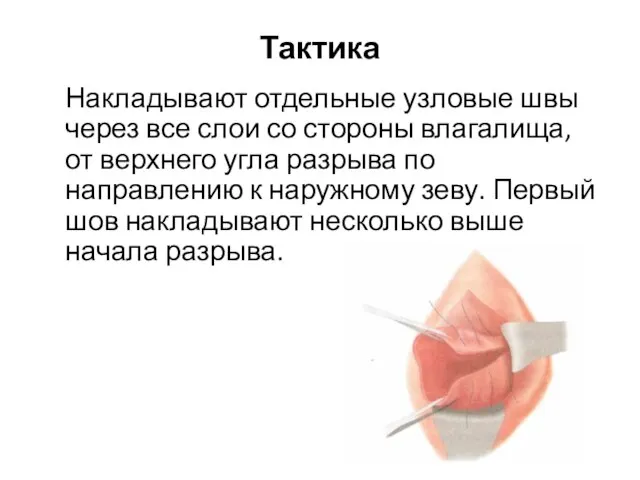 Тактика Накладывают отдельные узловые швы через все слои со стороны влагалища,