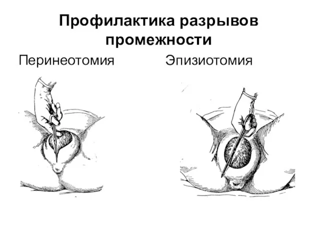 Профилактика разрывов промежности Перинеотомия Эпизиотомия