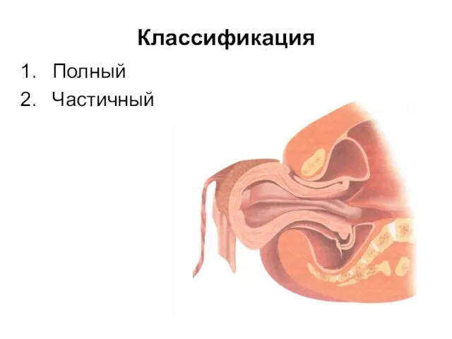 Классификация Полный Частичный