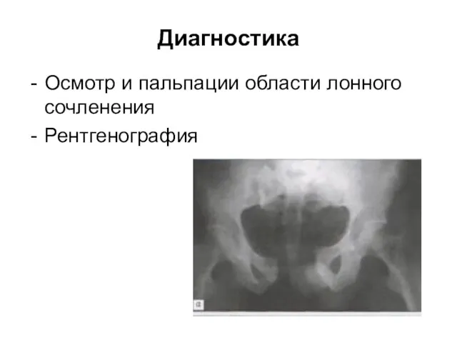 Диагностика Осмотр и пальпации области лонного сочленения Рентгенография