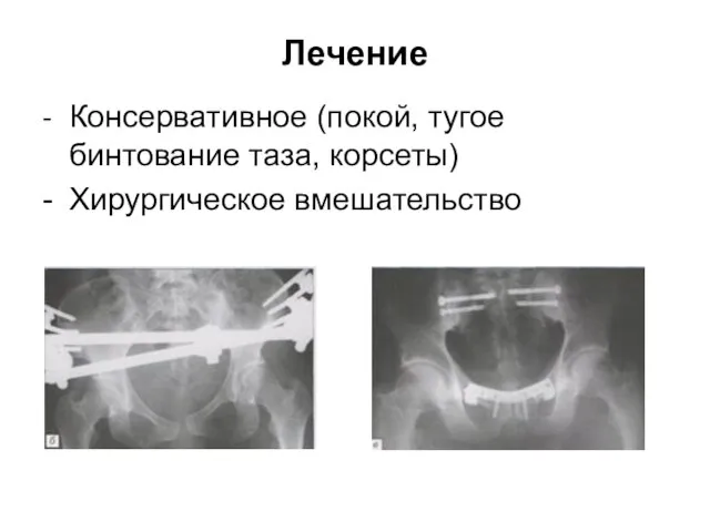 Лечение - Консервативное (покой, тугое бинтование таза, корсеты) - Хирургическое вмешательство