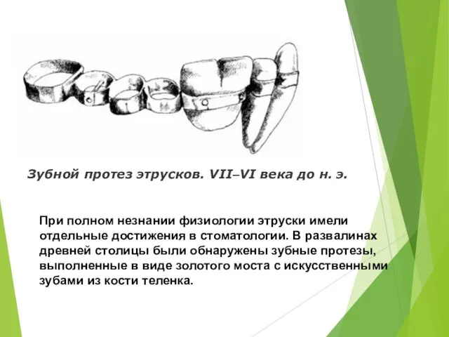 Зубной протез этрусков. VII–VI века до н. э. При полном незнании