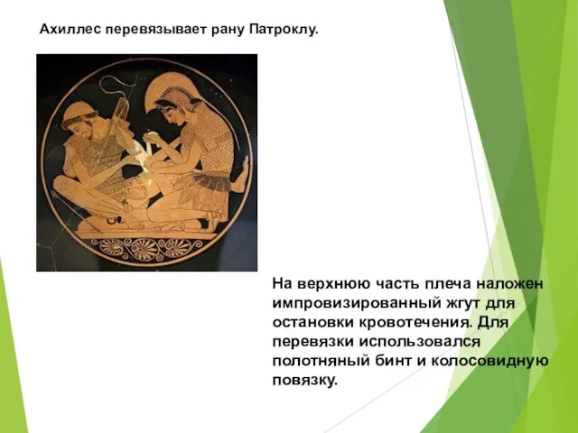 Ахиллес перевязывает рану Патроклу. На верхнюю часть плеча наложен импровизированный жгут