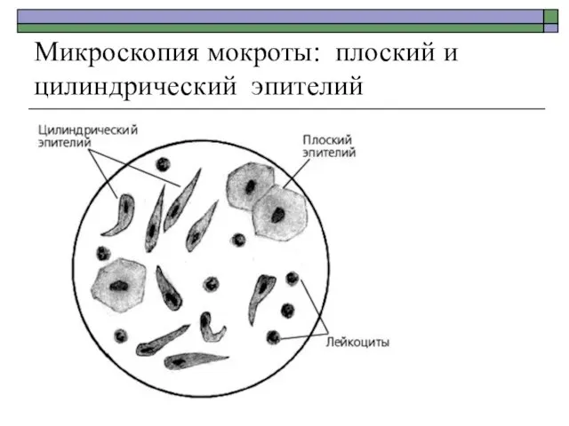 Микроскопия мокроты: плоский и цилиндрический эпителий