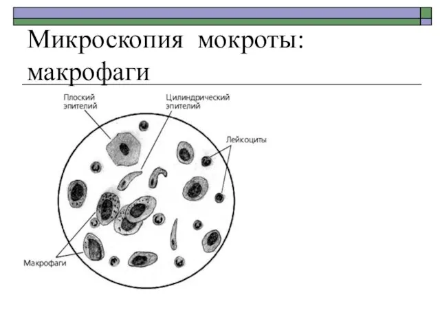 Микроскопия мокроты: макрофаги