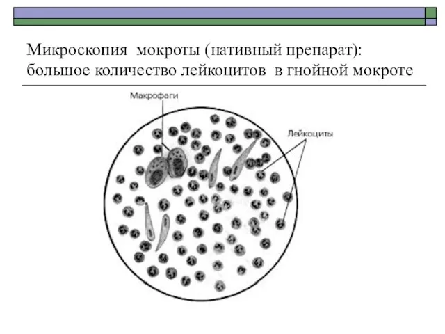 Микроскопия мокроты (нативный препарат): большое количество лейкоцитов в гнойной мокроте