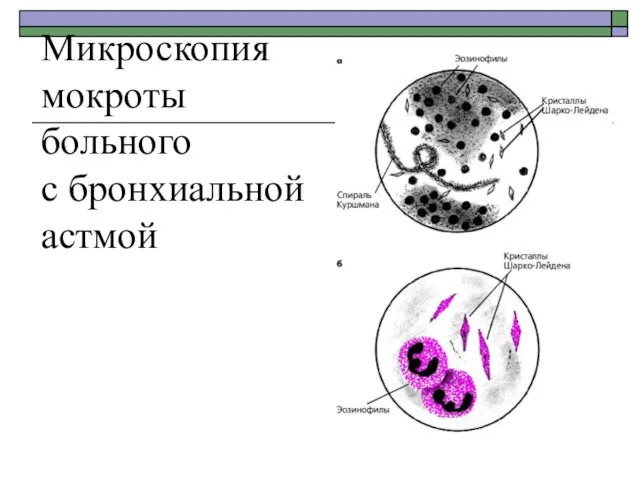 Микроскопия мокроты больного с бронхиальной астмой