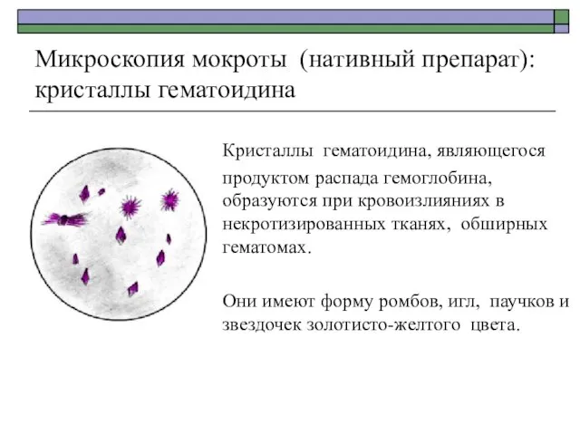 Микроскопия мокроты (нативный препарат): кристаллы гематоидина Кристаллы гематоидина, являющегося продуктом распада