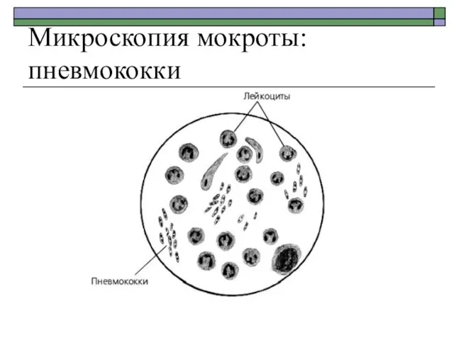 Микроскопия мокроты: пневмококки