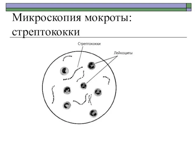 Микроскопия мокроты: стрептококки