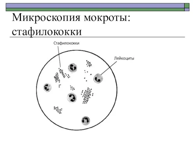 Микроскопия мокроты: стафилококки