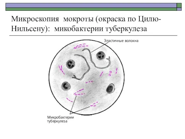 Микроскопия мокроты (окраска по Цилю- Нильсену): микобактерии туберкулеза