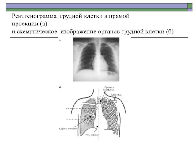 Рентгенограмма грудной клетки в прямой проекции (а) и схематическое изображение органов грудной клетки (б)