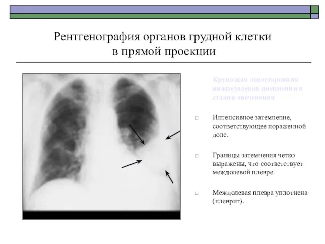 Рентгенография органов грудной клетки в прямой проекции Крупозная левосторонняя нижнедолевая пневмония