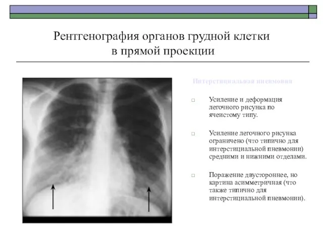 Рентгенография органов грудной клетки в прямой проекции Интерстициальная пневмония Усиление и