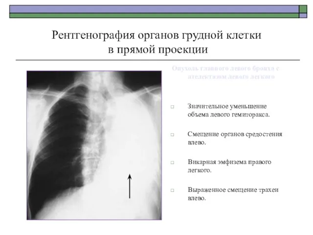 Рентгенография органов грудной клетки в прямой проекции Опухоль главного левого бронха