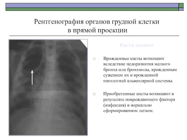 Киста легкого Врожденные кисты возникают вследствие недоразвития мелкого бронха или бронхиолы,