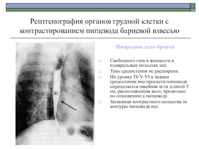 Рентгенография органов грудной клетки с контрастированием пищевода бариевой взвесью Инородное тело