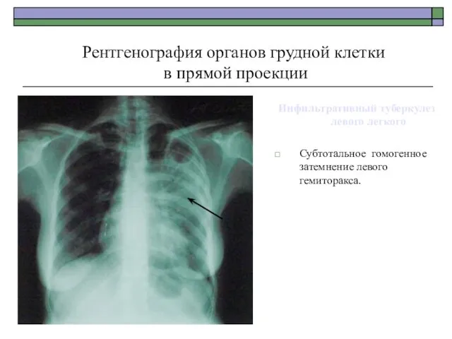 Инфильтративный туберкулез левого легкого Субтотальное гомогенное затемнение левого гемиторакса. Рентгенография органов грудной клетки в прямой проекции