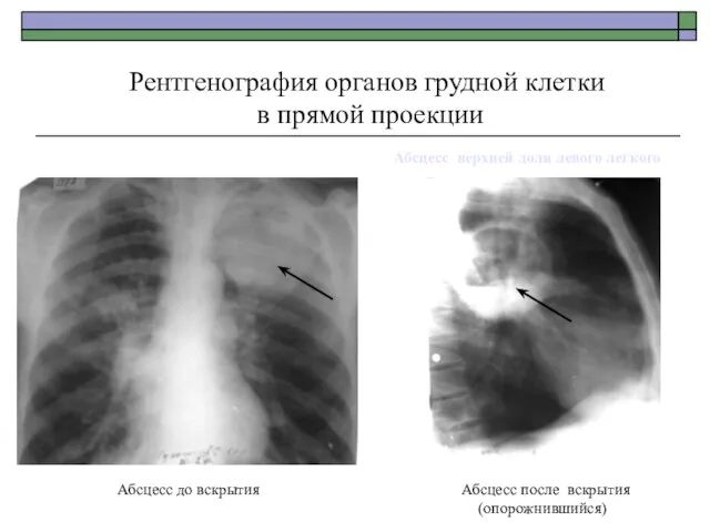 Абсцесс после вскрытия (опорожнившийся) Рентгенография органов грудной клетки в прямой проекции