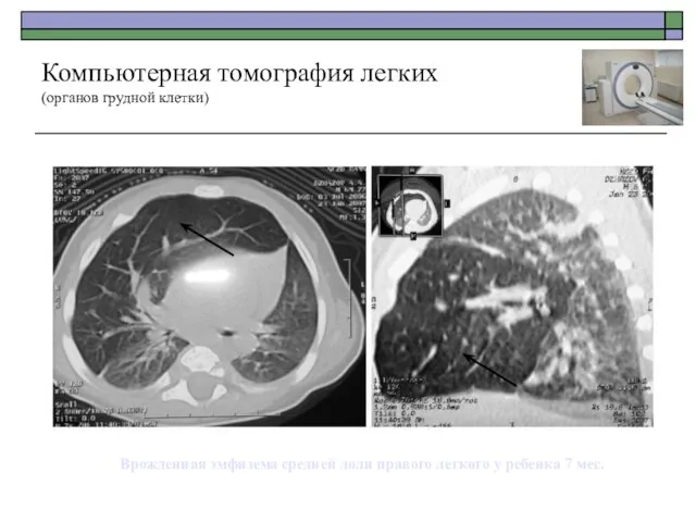 Компьютерная томография легких (органов грудной клетки) Врожденная эмфизема средней доли правого легкого у ребенка 7 мес.