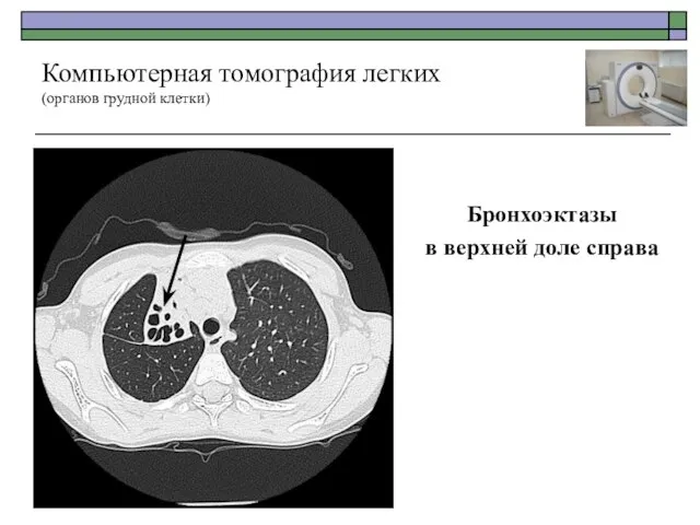 Бронхоэктазы в верхней доле справа Компьютерная томография легких (органов грудной клетки)