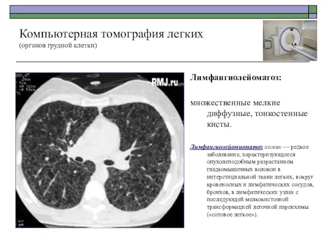 Лимфангиолейоматоз: множественные мелкие диффузные, тонкостенные кисты. Лимфангиолейомиоматоз легких — редкое заболевание,