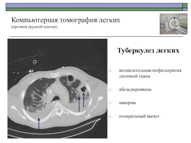 Туберкулез легких воспалительная инфильтрация легочной ткани абсцедирование каверны плевральный выпот Компьютерная томография легких (органов грудной клетки)