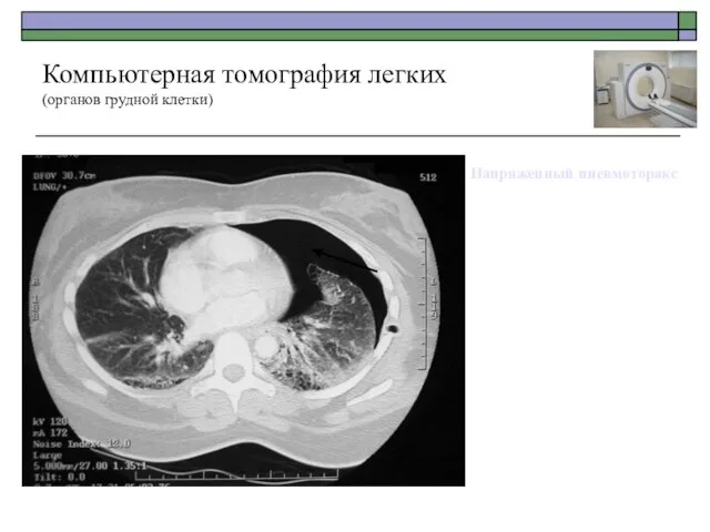 Напряженный пневмоторакс Компьютерная томография легких (органов грудной клетки)