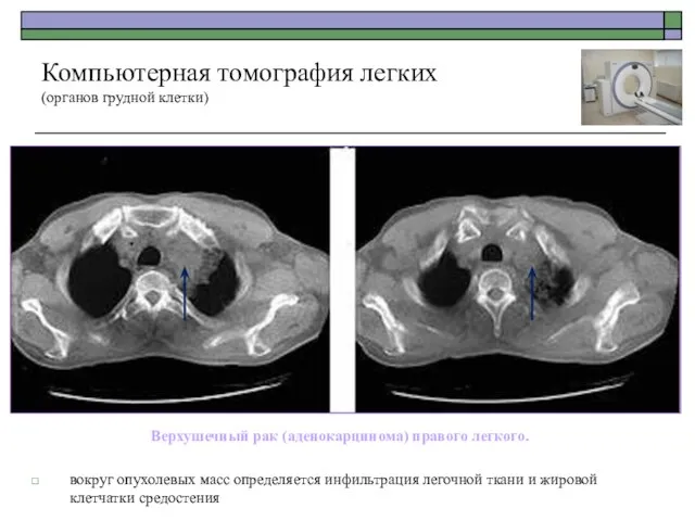 Верхушечный рак (аденокарцинома) правого легкого. вокруг опухолевых масс определяется инфильтрация легочной