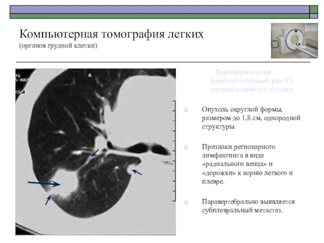 Периферический плоскоклеточный рак VI сегмента правого легкого Опухоль округлой формы, размером