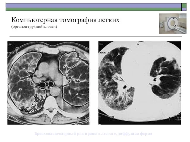 Бронхоальвеолярный рак правого легкого, диффузная форма Компьютерная томография легких (органов грудной клетки)