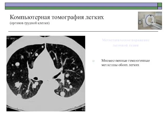 Метастатическое поражение легочной ткани Множественные гематогенные метастазы обоих легких Компьютерная томография легких (органов грудной клетки)