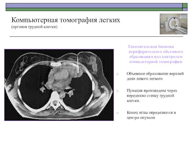 Тонкоигольная биопсия периферического объемного образования под контролем компьютерной томографии Объемное образование