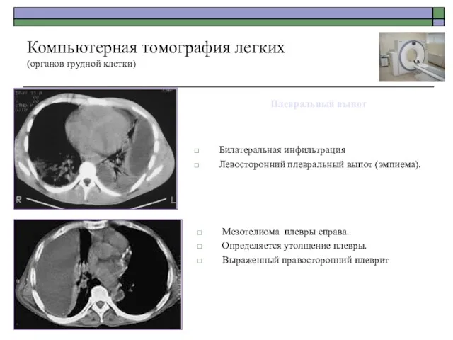 Билатеральная инфильтрация Левосторонний плевральный выпот (эмпиема). Компьютерная томография легких (органов грудной