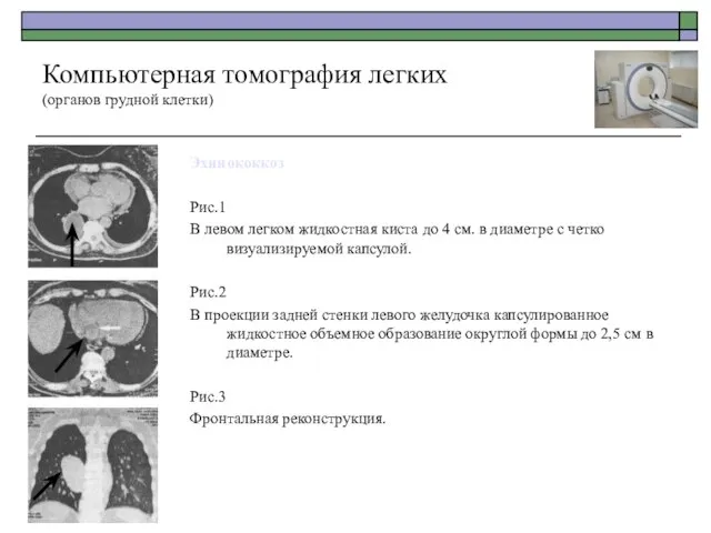 Эхинококкоз Рис.1 В левом легком жидкостная киста до 4 см. в