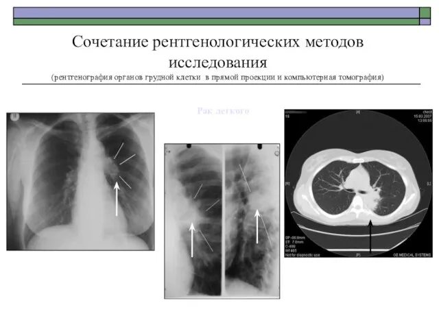 Рак легкого Рак легкого Сочетание рентгенологических методов исследования (рентгенография органов грудной