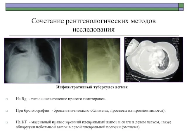 Сочетание рентгенологических методов исследования Инфильтративный туберкулез легких На Rg - тотальное