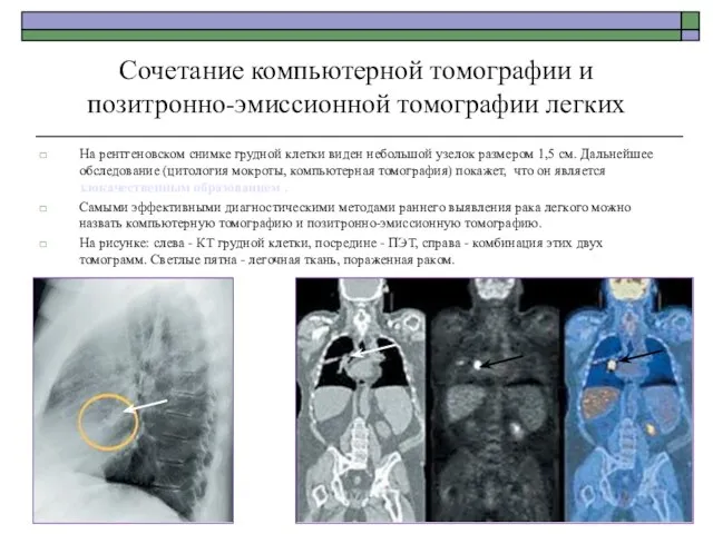 Сочетание компьютерной томографии и позитронно-эмиссионной томографии легких На рентгеновском снимке грудной