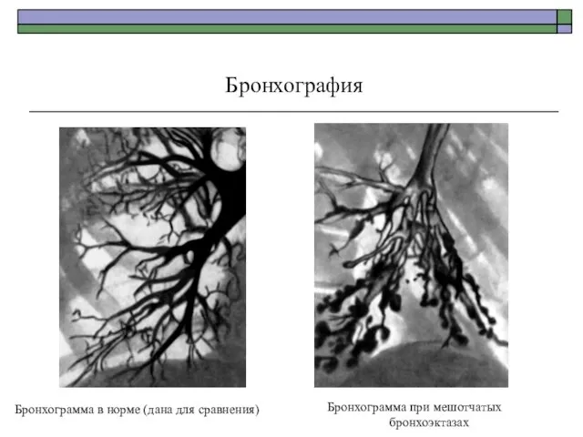 Бронхография Бронхограмма при мешотчатых бронхоэктазах Бронхограмма в норме (дана для сравнения)