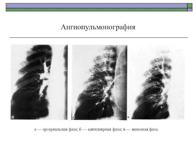 Ангиопульмонография а — артериальная фаза; б — капиллярная фаза; в — венозная фаза.