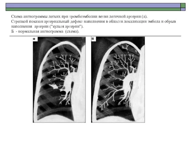Схема ангиограммы легких при тромбоэмболии ветви легочной артерии (а). Стрелкой показан