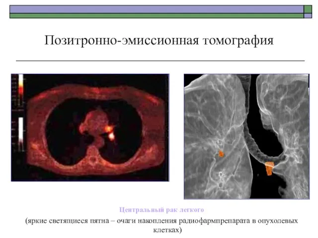 Позитронно-эмиссионная томография Центральный рак легкого (яркие светящиеся пятна – очаги накопления радиофармпрепарата в опухолевых клетках)