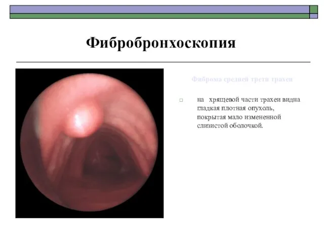 Фиброма средней трети трахеи на хрящевой части трахеи видна гладкая плотная